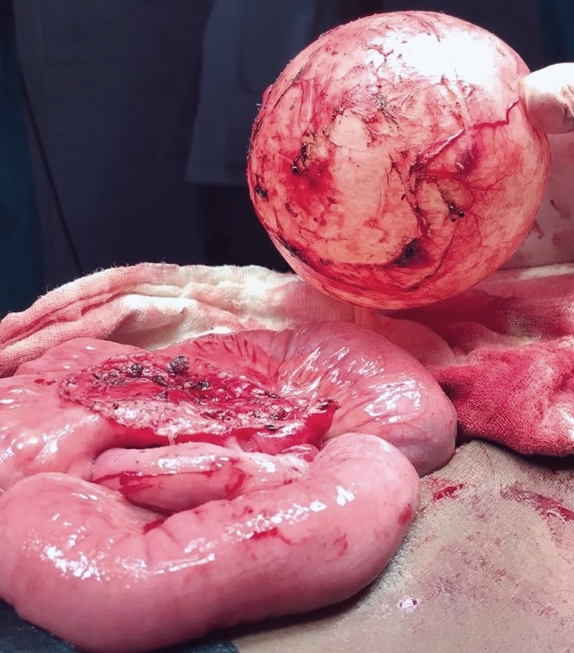 Admin/uploads/28_05_201900_32Mesenteric Cyst.jpg